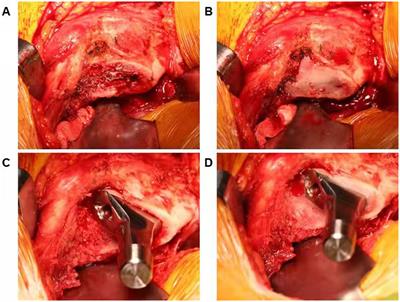 Bone wax reduces blood loss after total hip arthroplasty: a prospective, randomized controlled study